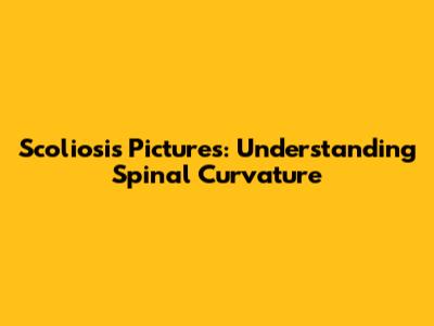 Scoliosis Pictures: Understanding Spinal Curvature